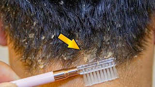 Dandruff Treatment At Home Big Flakes Dandruff Removal [upl. by Trebron139]