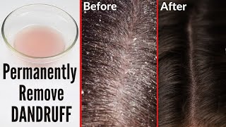 How to cure dandruff permanently naturally at home [upl. by Mackenie]