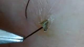 Ingrown Hair 埋没毛の救出！PART9（再アップ） [upl. by Hughett]