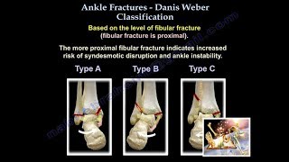 Ankle Fractures Danis Weber Classification  Everything You Need To Know  Dr Nabil Ebraheim [upl. by Enneirb243]