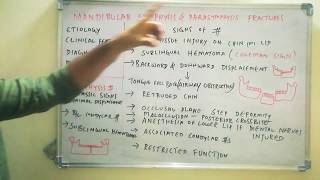 Mandibular symphysisparasymphysis fractures [upl. by Ativoj935]