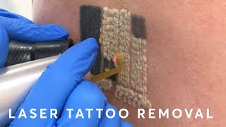 Laser Tattoo Removal PAIN RESULTS amp PROCEDURE [upl. by Manchester681]