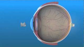 Intraocular Lens IOL [upl. by Codel]