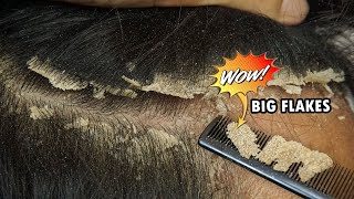 Itchy Scalp Dandruff Removal Satisfying 560 [upl. by Mellisa82]