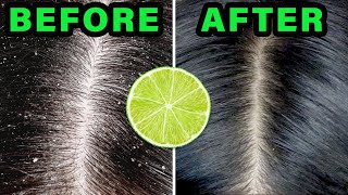 How to REMOVE DANDRUFF in 10 minutes USING LEMON JUICE [upl. by Iphigeniah]