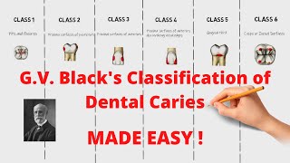 GV Blacks Classification of Dental Caries Quick and Complete Revision [upl. by Hpeosj]