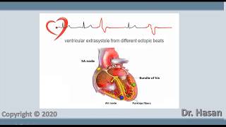 Extrasystole  Premature contraction  atrial nodal and ventricular extrasystole [upl. by Annauqahs]